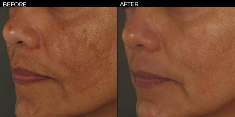 Hydroquinone